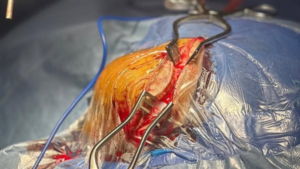 إنجاز طبي جديد.. “الصحة” تكشف تفاصيل إجراء جراحة في المخ بتقنية “ثلاثية الأبعاد” إنجاز طبي جديد.. “الصحة” تكشف تفاصيل إجراء جراحة في المخ بتقنية “ثلاثية الأبعاد”